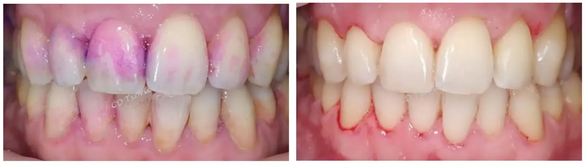 Una fotografía de antes y después de los dientes de una persona.