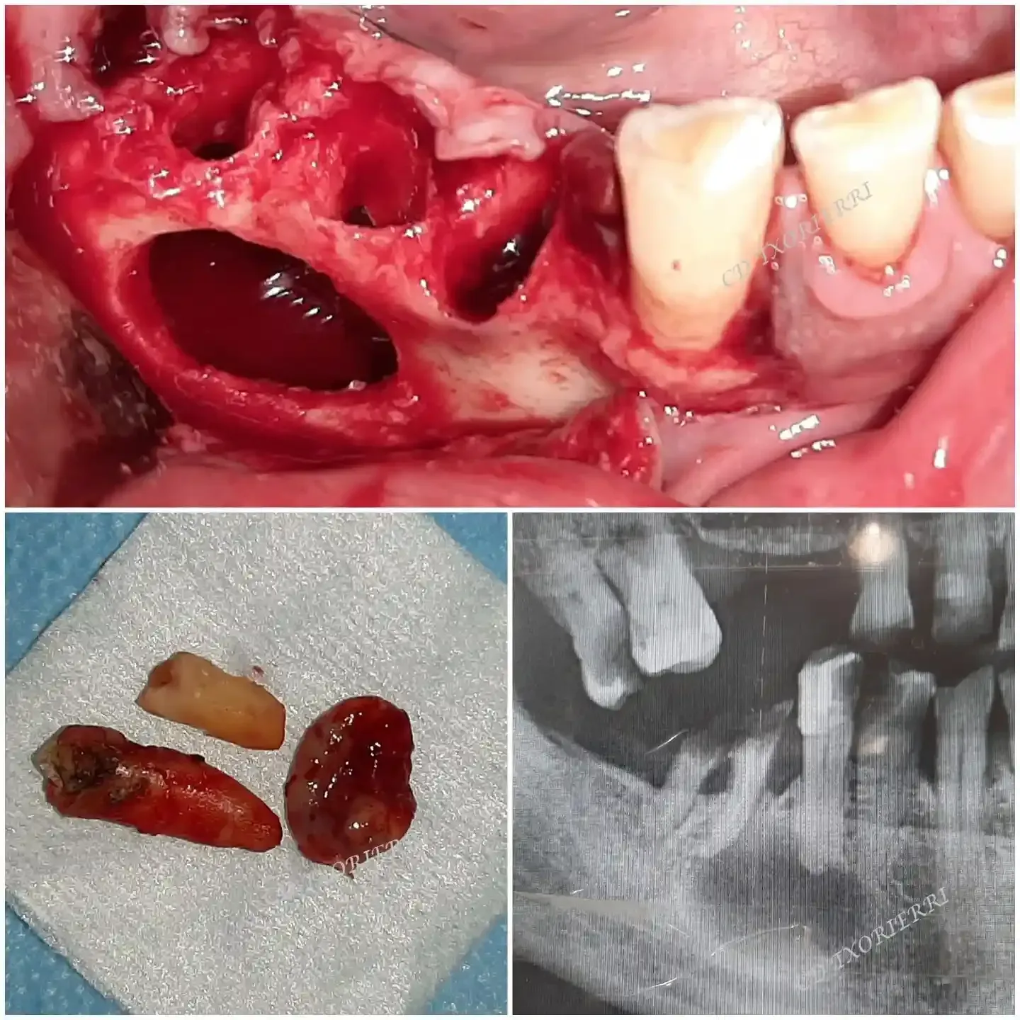 cirugia dental y extraccion de muelas 