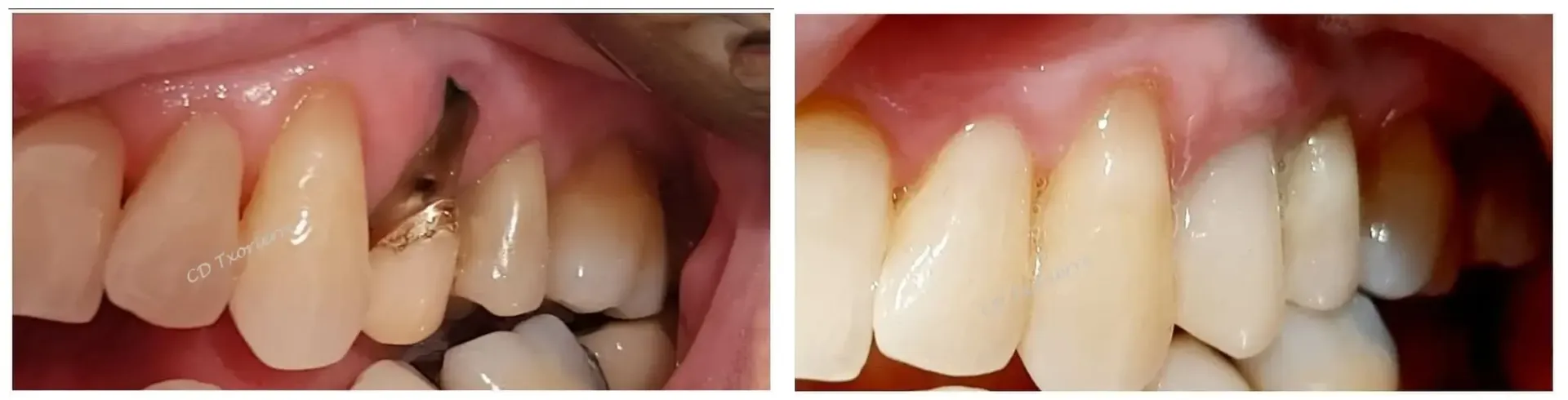 Una fotografía de antes y después de los dientes de una persona.