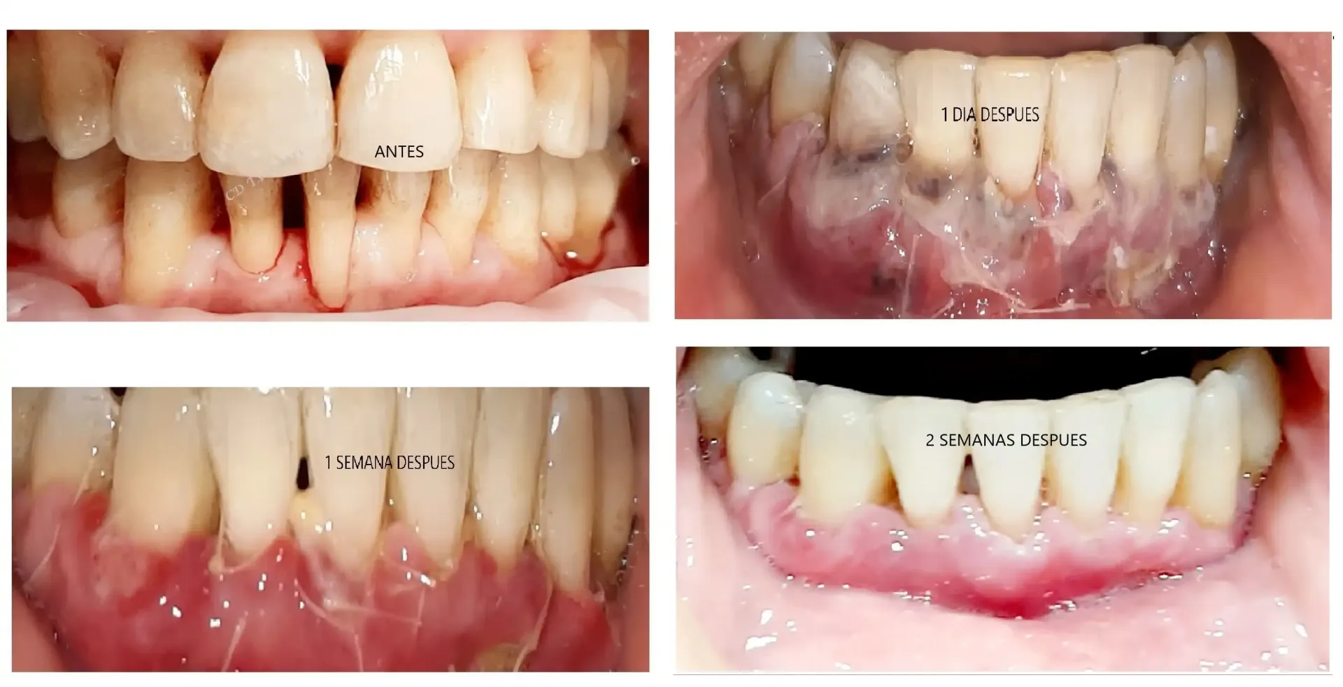 Una fotografía de antes y después de los dientes de una persona.