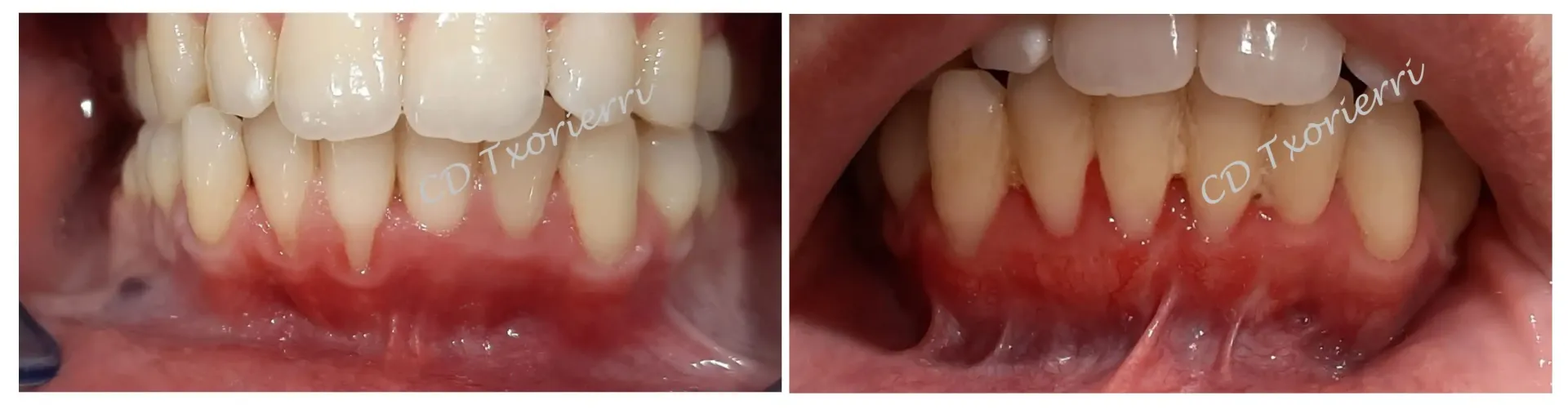 Una fotografía de antes y después de los dientes de una persona.