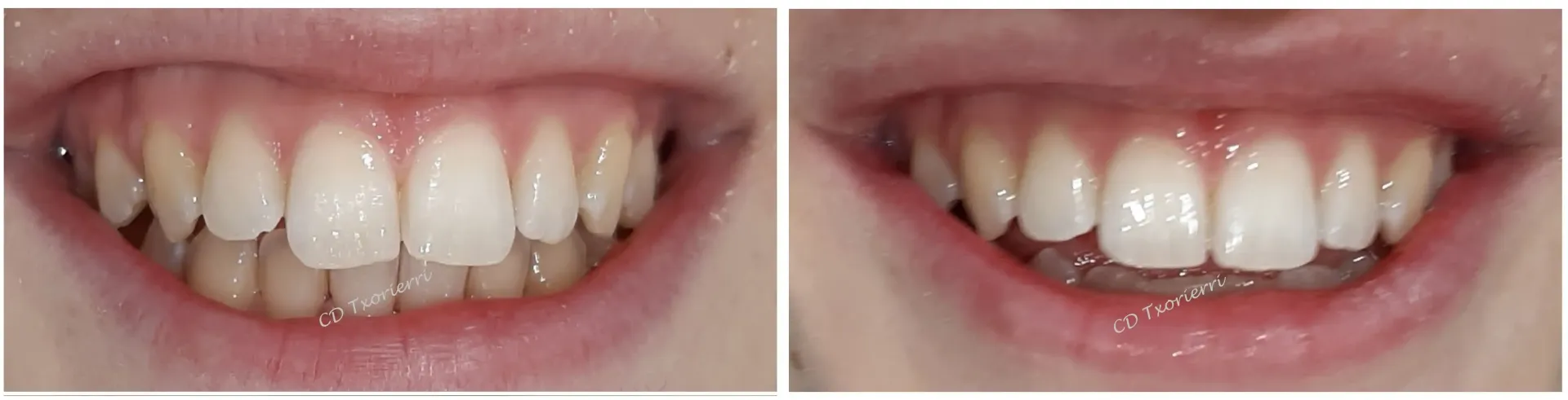 Una fotografía de antes y después de los dientes de una persona.