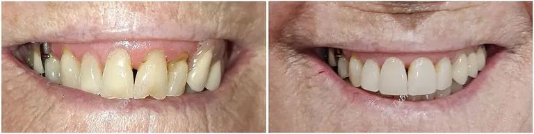 Una fotografía de antes y después de los dientes de una persona.