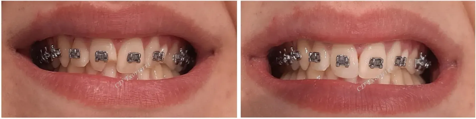 Una fotografía de antes y después de los dientes de una persona con aparatos ortopédicos.