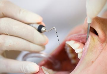 Un primer plano de una persona a la que un dentista le examina los dientes.