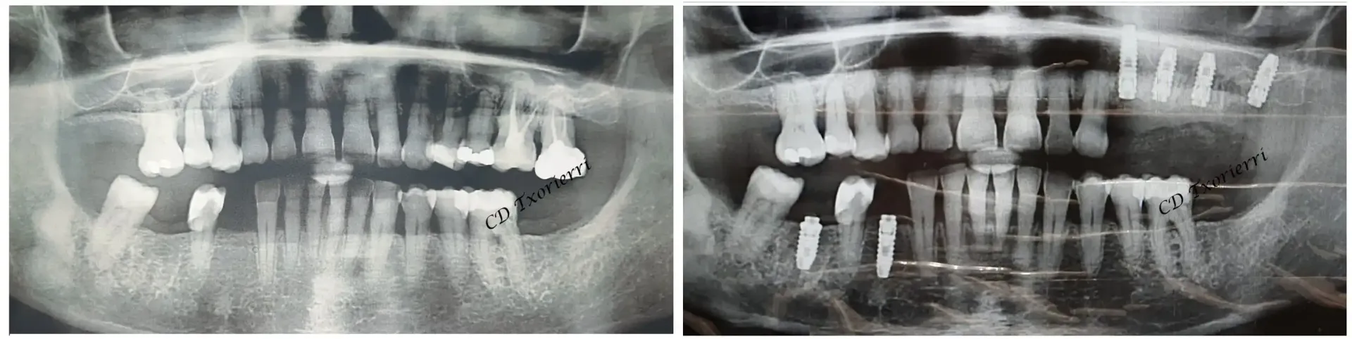 Una radiografía de los dientes de una persona antes y después.