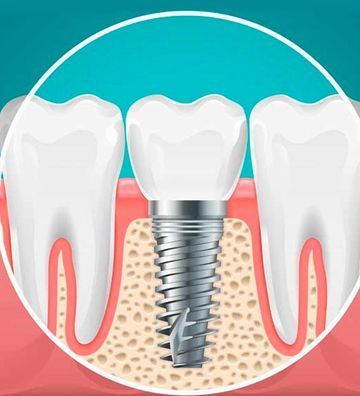 Una ilustración de un implante dental entre dos dientes.