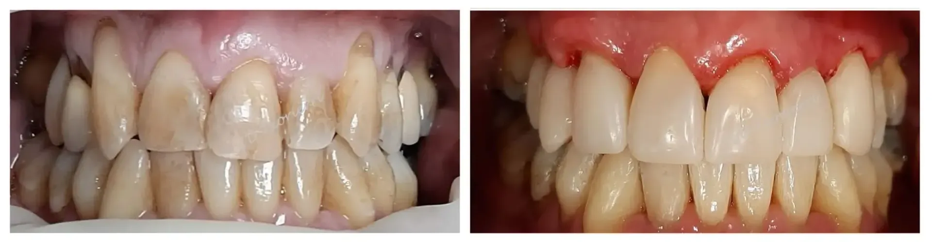 Una fotografía de antes y después de los dientes de una persona.