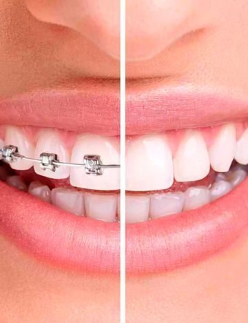 Una fotografía de antes y después de los dientes de una mujer con aparatos dentales.
