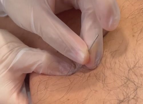 Una mano enguantada inserta una aguja en la piel humana, probablemente para un procedimiento médico.