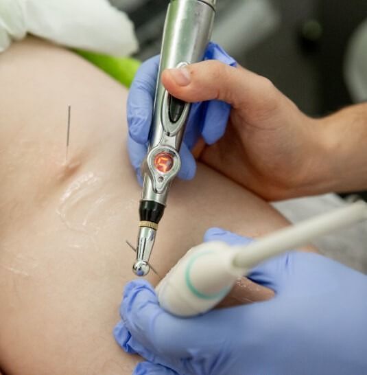 Persona que recibe tratamiento de electroacupuntura en el abdomen; el practicante utiliza una sonda y agujas.