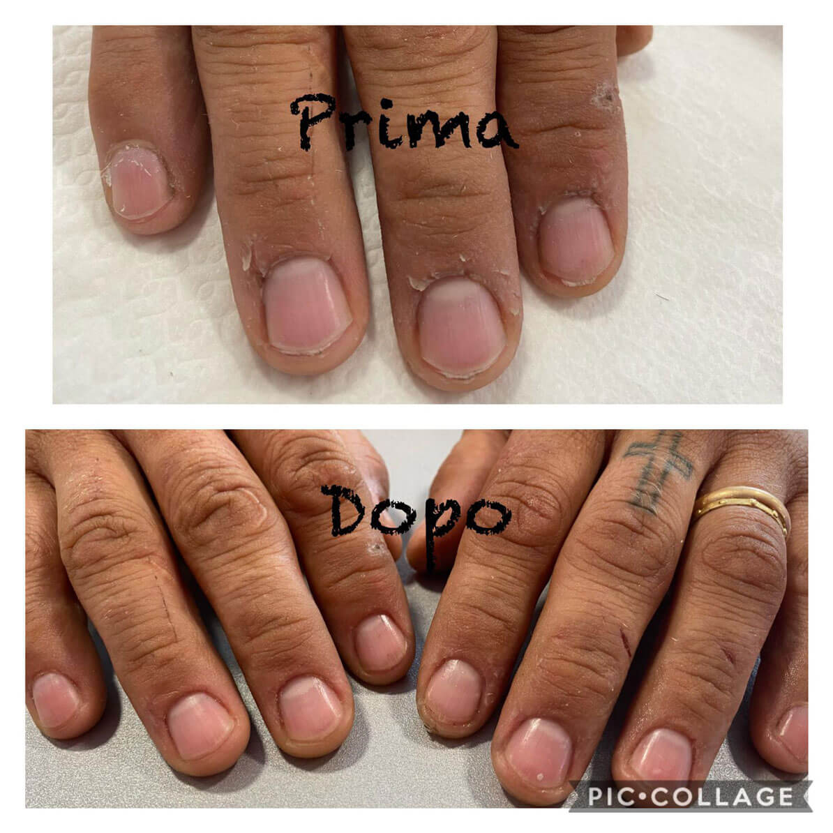 ricostruzione unghie prima e dopo - Alessandro Santullo