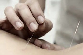 Mano insertando agujas de acupuntura en la espalda de una persona.