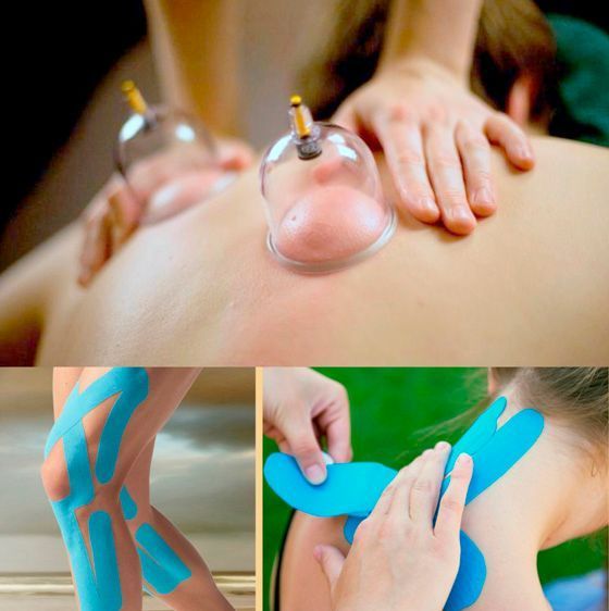 Terapia con ventosas y aplicación de cinta Kinesio en partes del cuerpo.