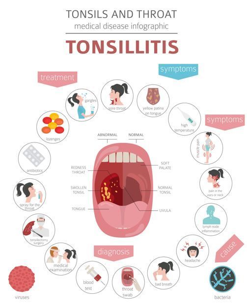 Infografía de una garganta con amigdalitis, que ilustra los síntomas, el tratamiento, la causa y el diagnóstico.