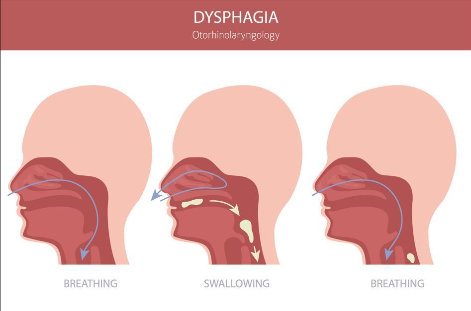 Diagrama que ilustra el proceso de respiración y deglución, representando la disfagia.