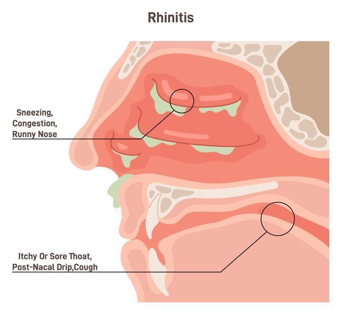 Diagrama de la nariz y la garganta que muestra los síntomas de la rinitis.