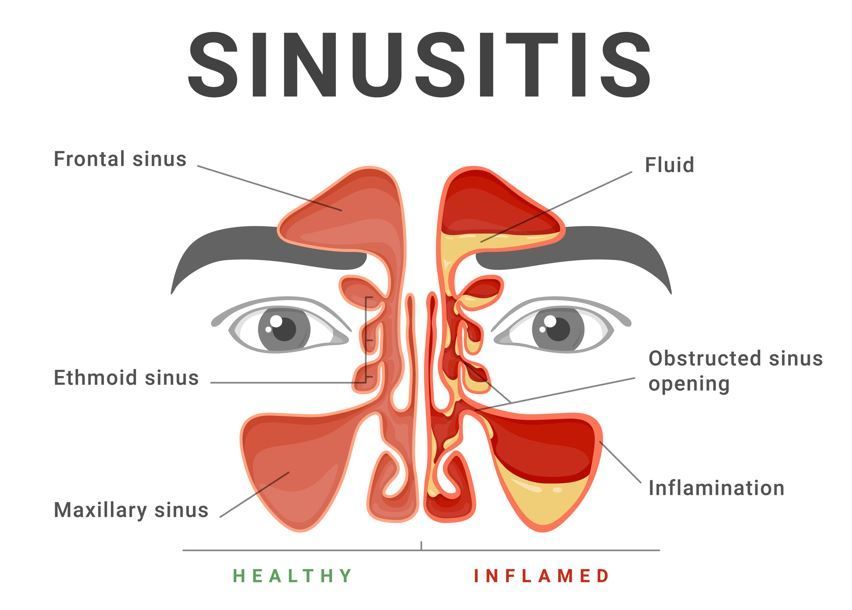 Diagrama comparativo de senos paranasales sanos e inflamados.