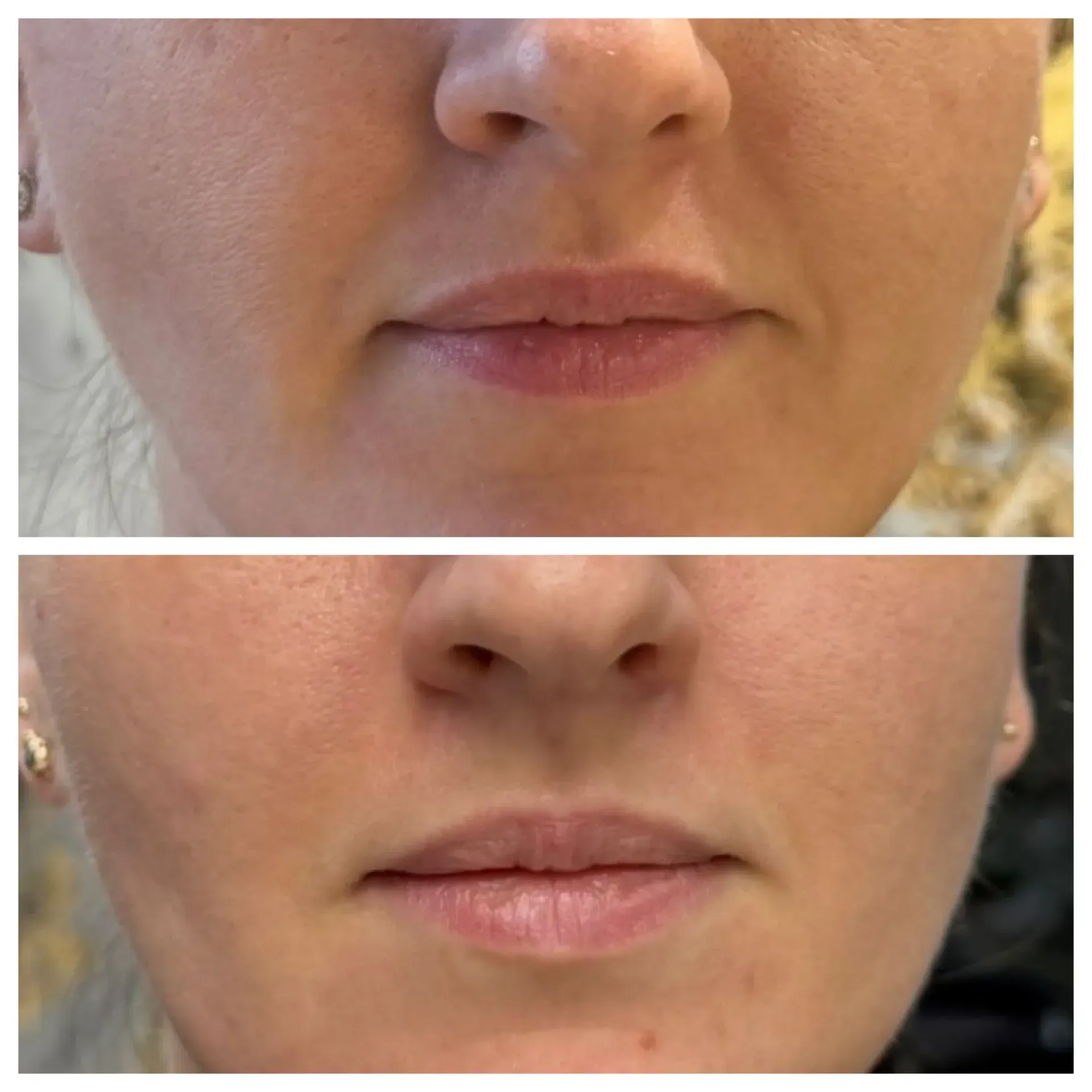 Comparación lado a lado del labio superior