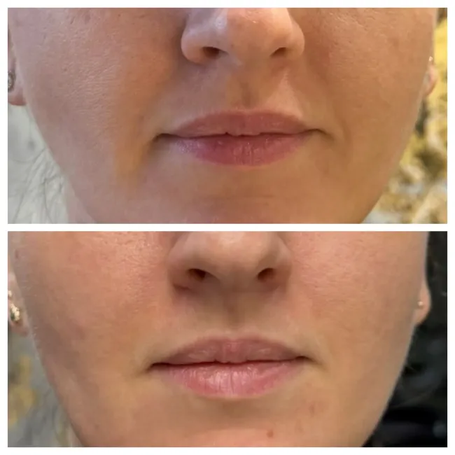 Comparación lado a lado del labio superior 
