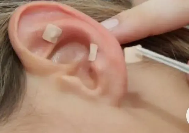 Una persona está recibiendo acupuntura en su oído.