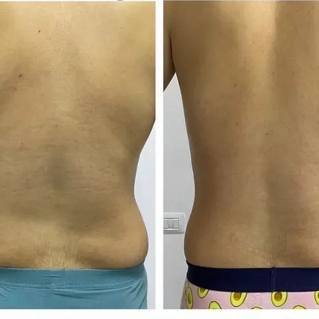 Una fotografía de antes y después de la espalda de un hombre.