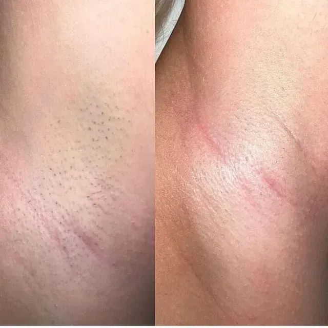 Una fotografía de antes y después de la axila de una persona.