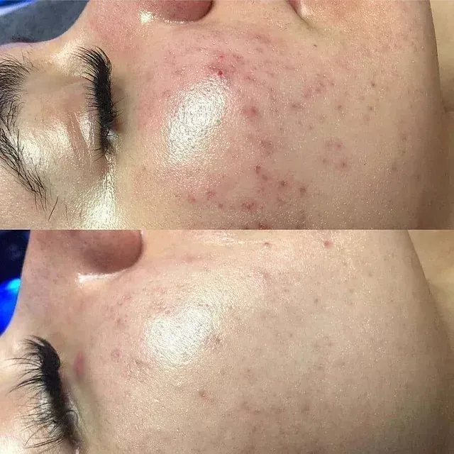 Una fotografía de antes y después del rostro de una mujer con acné.