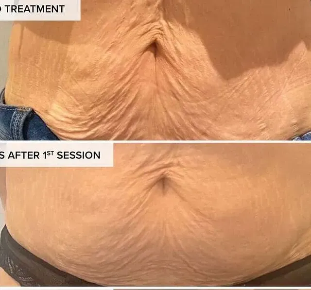 Se muestra el estómago de una mujer antes y después de un tratamiento.