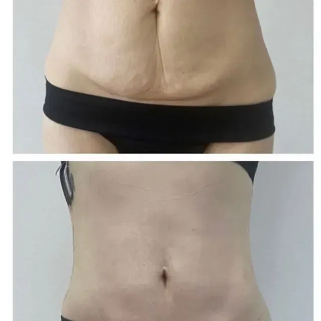 El estómago de una mujer antes y después de la cirugía.