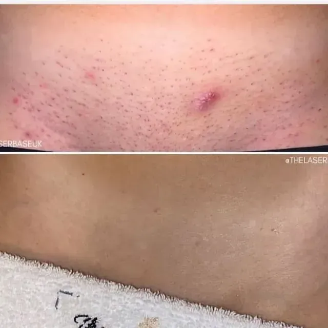 Una foto de antes y después de la axila de una mujer con una toalla.