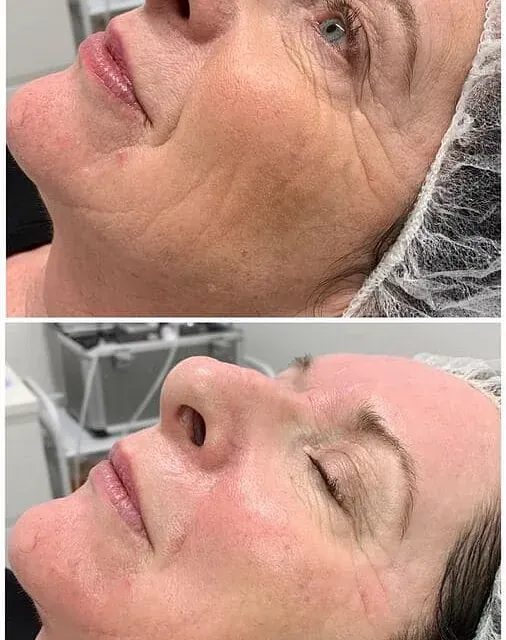 Una fotografía de antes y después del rostro de una mujer.