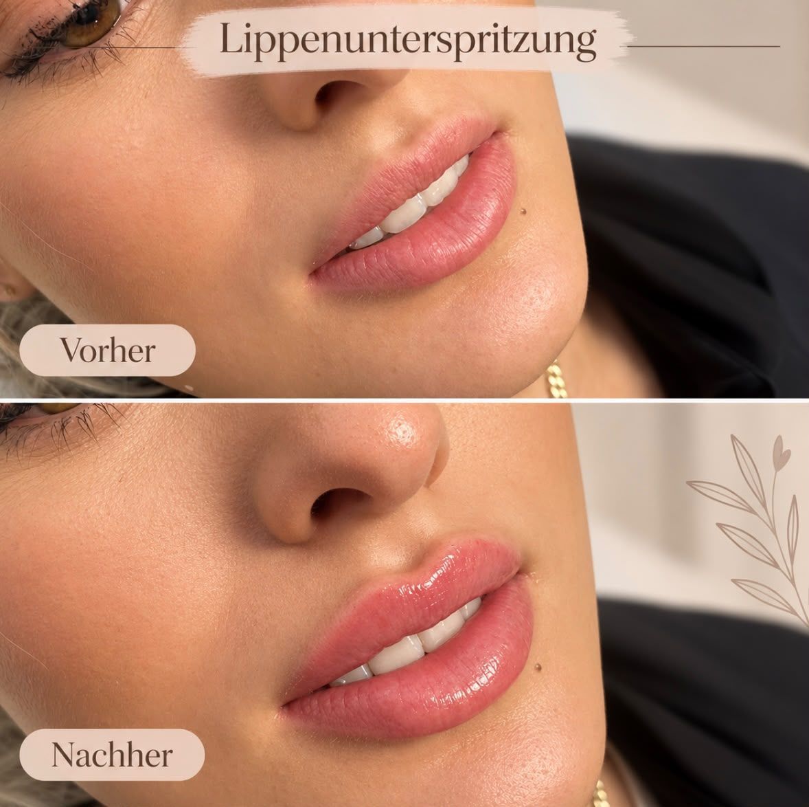 Lippenunterspritzung: Vorher-Nachher-Vergleich, Beispiel 1