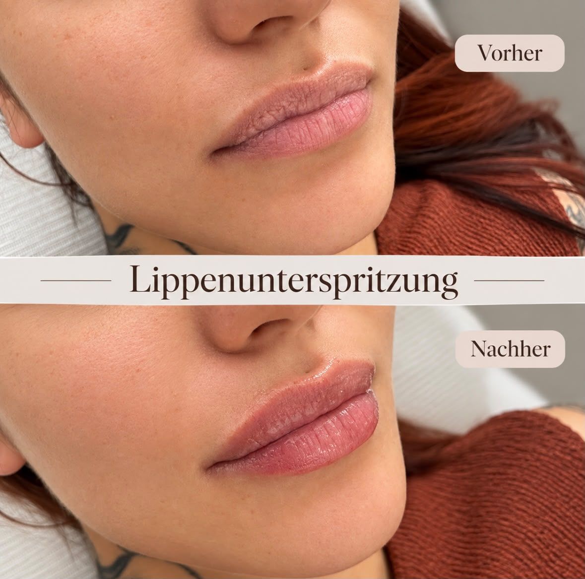 Lippenunterspritzung: Vorher-Nachher-Vergleich, Beispiel 2