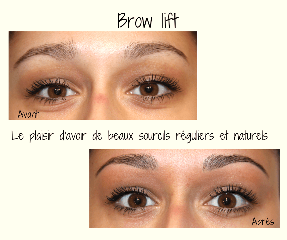 Brow Lift