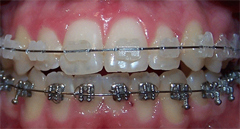 Un primer plano de los dientes de una persona con aparatos transparentes.