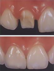Una fotografía de antes y después de los dientes de una persona.
