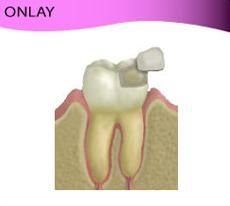 Una imagen de un diente con una corona dental.