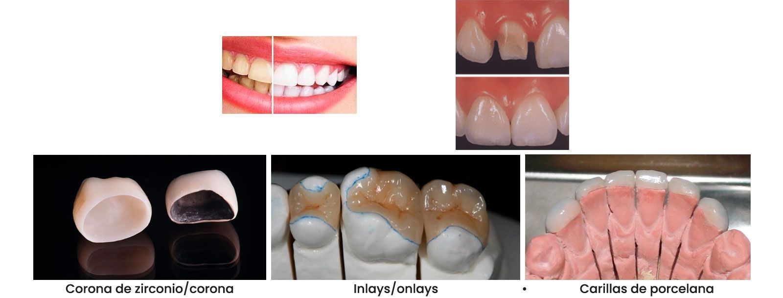 Una imagen de los dientes de una persona y una imagen de una corona dental.