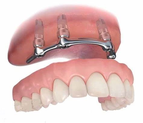 Un primer plano de los dientes de una persona con un puente dental.
