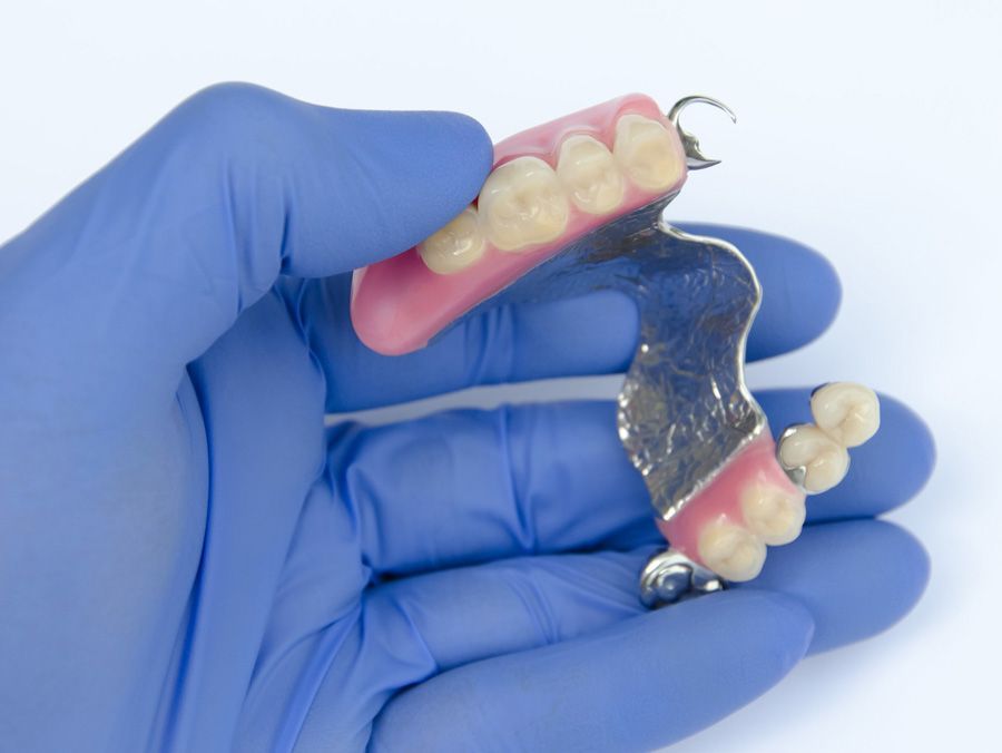 Una persona que lleva guantes azules sostiene una dentadura postiza en la mano.