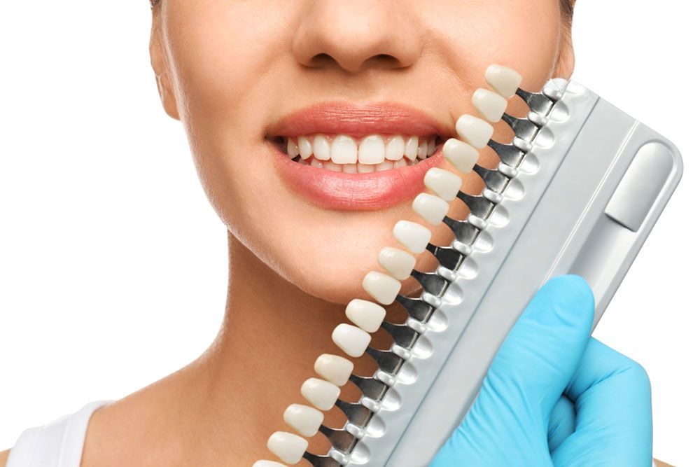 Veneers