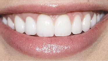 Dental bridge