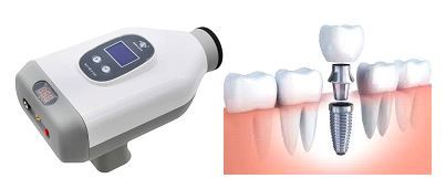 Οδοντικά Εμφυτεύματα