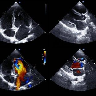 Quatro painéis de ecocardiograma, incluindo imagens do coração em escala de cinza e fluxo sanguíneo com Doppler colorido.