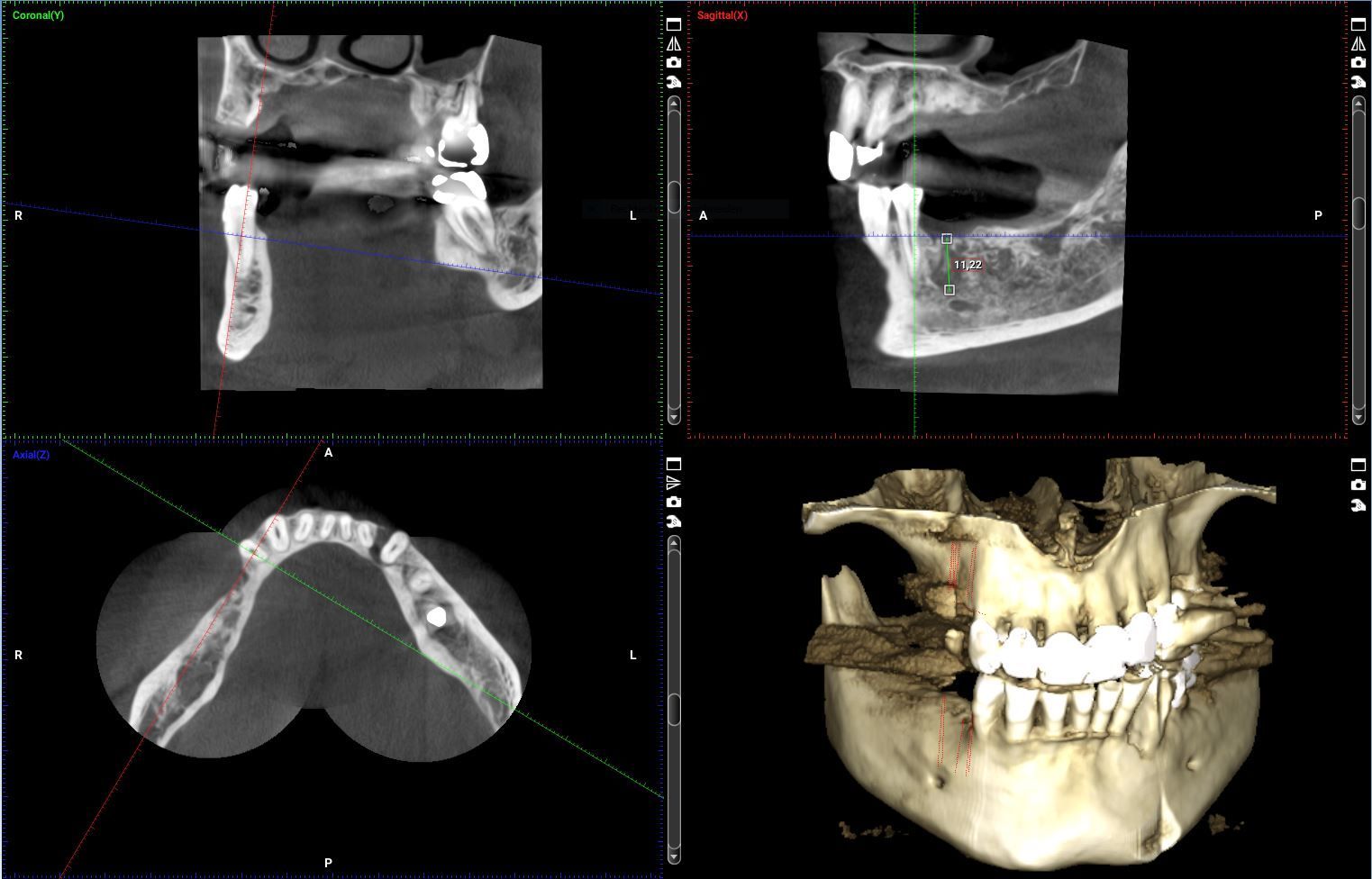 DVT-Aufnahmen des Kiefers mit 3D-Darstellung zur zahnmedizinischen Diagnostik von Knochen, Zähnen und Nervenverläufen