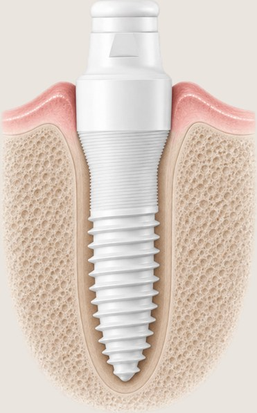 Keramikimplantat mit Gewinde im Kieferknochen und Zahnfleisch