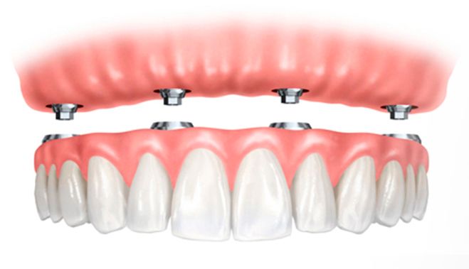 Un primer plano de los dientes de una persona con implantes dentales.