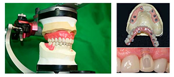 Un modelo de los dientes de una persona y una imagen de una dentadura postiza.