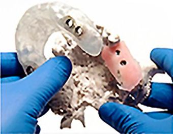 Una persona que lleva guantes azules sostiene un modelo dental en sus manos.